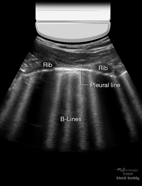 COVID-19 Lung Ultrasound Abnormal Lung Scan