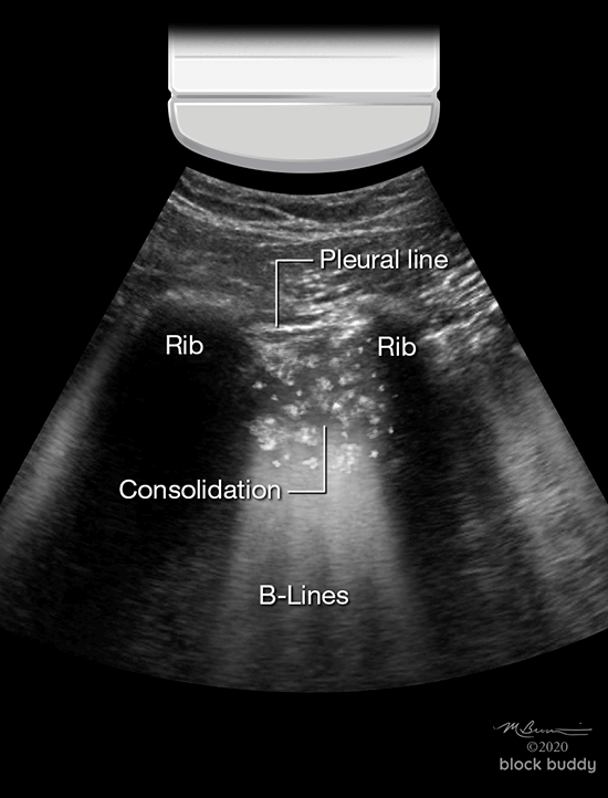 COVID-19 Lung Ultrasound Abnormal Lung Scan Consolidation