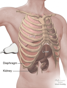 COVID-19 Lung Ultrasound Pleural Effusion Illustration