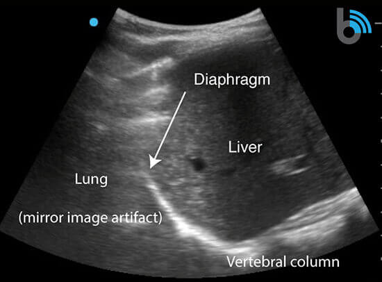 COVID-19 Lung Ultrasound Pleural Effusion Scan