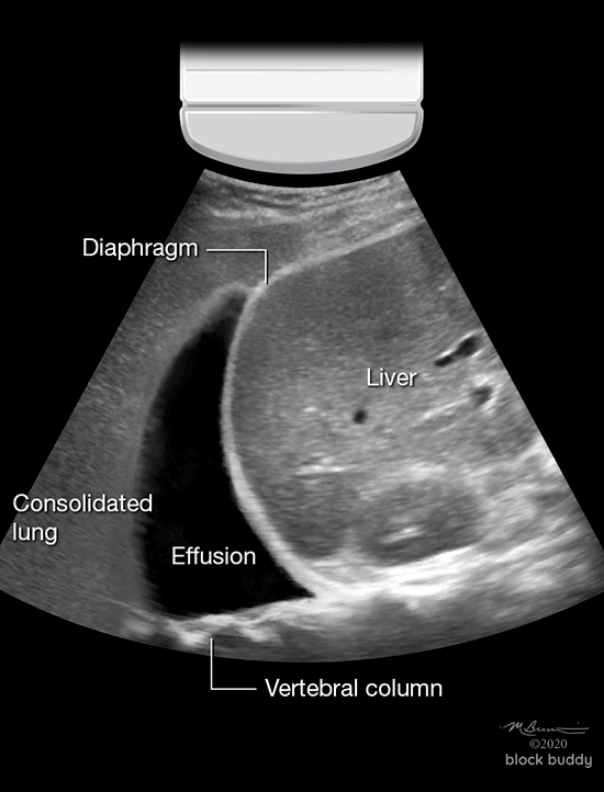 COVID-19 Lung Ultrasound Pleural Effusion Scan Vertebral Column