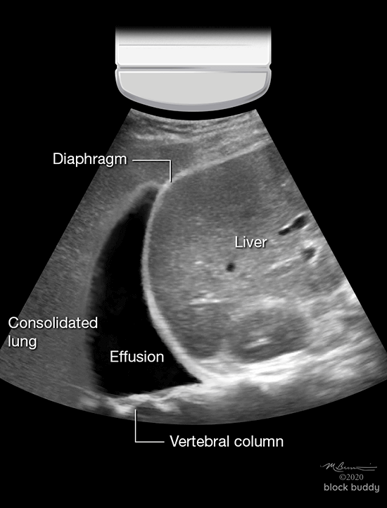 COVID-19 Lung Ultrasound | Lung Ultrasound Lesson