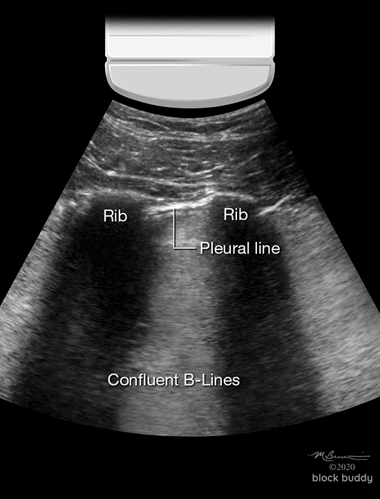 COVID-19 Lung Ultrasound Pulmonary Edema