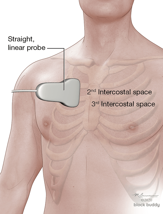 COVID-19 Lung Ultrasound Pneumothorax Diagram