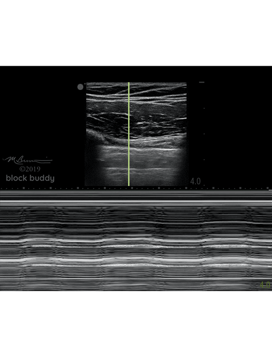 COVID-19 Lung Ultrasound