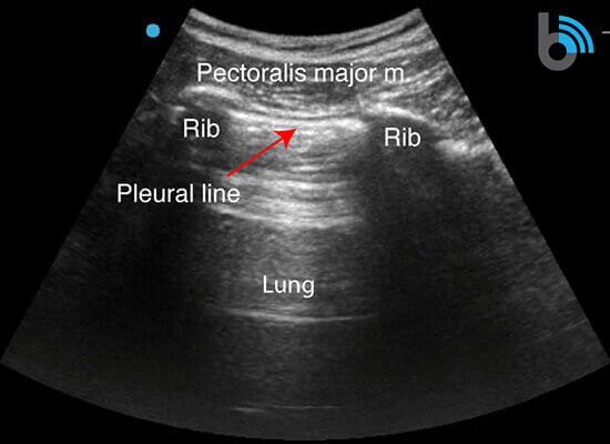 COVID-19 Lung Ultrasound Pleural Line Scan