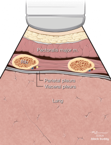 COVID-19 Lung Ultrasound Lung Diagram