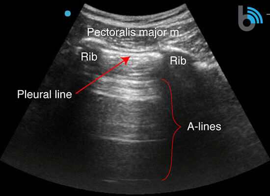 COVID-19 Lung Ultrasound Scan Diagram