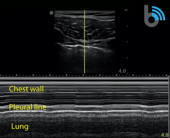 COVID-19 Lung Ultrasound Scan Chest Wall, Pleural Line & Lung