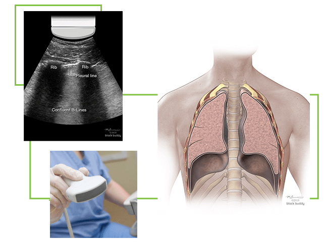 COVID-19 Lung Ultrasound Scans & Illustration
