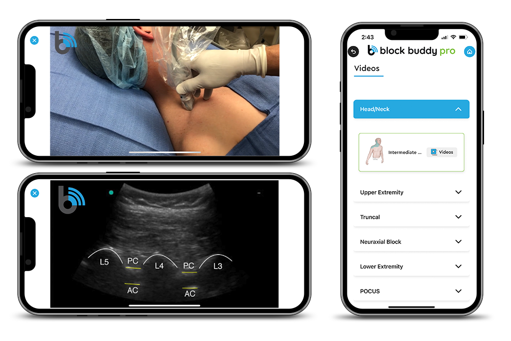 Screen Views of Block Buddy App Videos of Ultrasound Guided Nerve Blocks